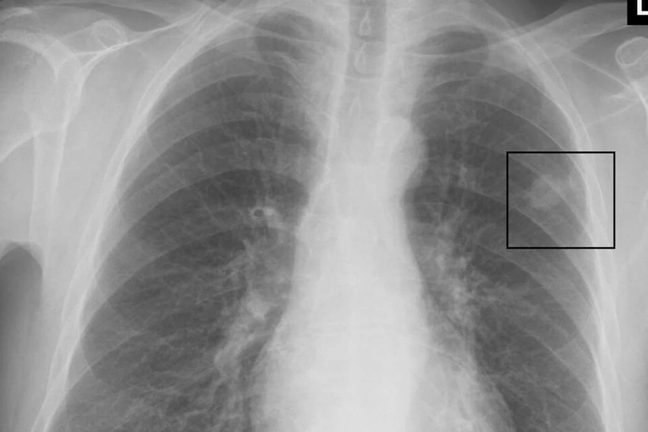 nódulo pulmonar